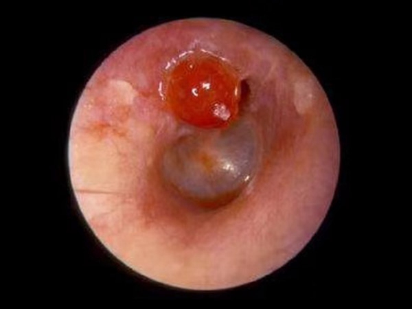 耳膽脂瘤